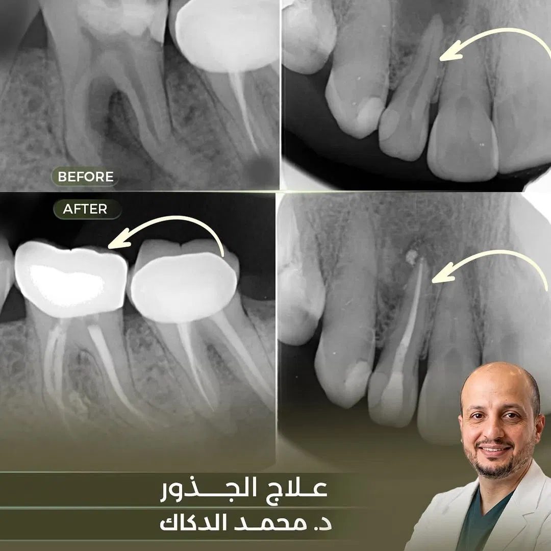 حالة علاج الجذور قبل وبعد، د. محمد الدكاك، عيادات لافي الرياض