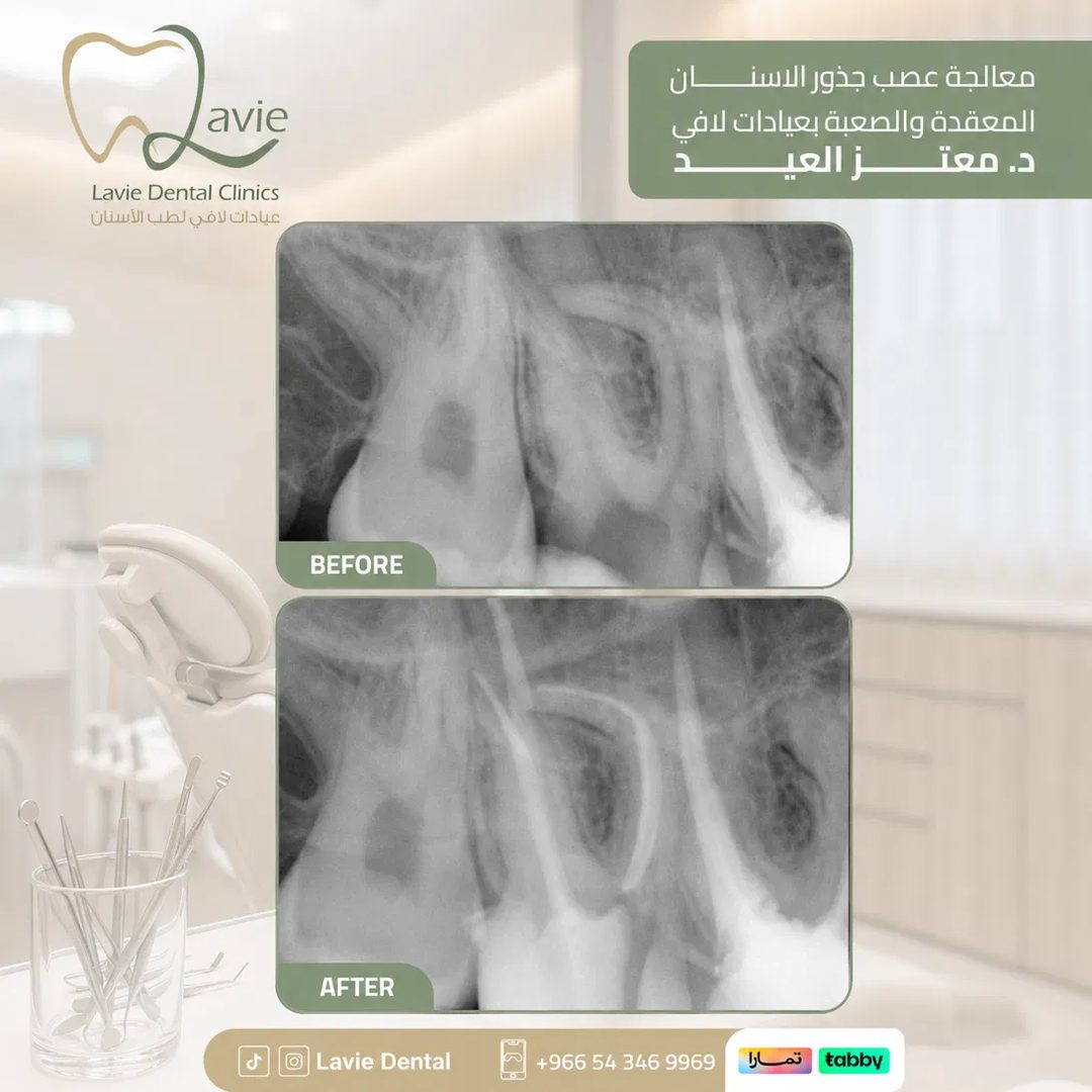 حالة علاج الجذور المعقدة قبل وبعد، د. معتز العيد، عيادات لافي الرياض