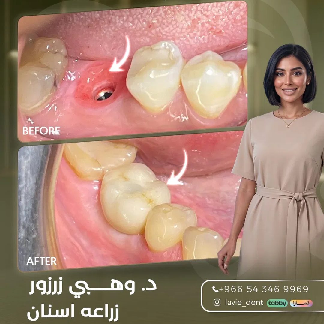 حالة زراعة الأسنان قبل وبعد، د. وهبي زرزور، عيادات لافي الرياض