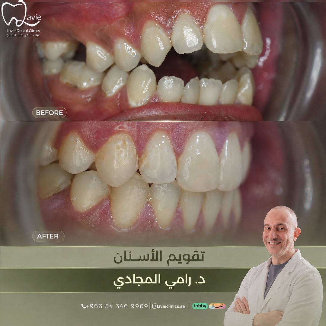 حالة تقويم الأسنان قبل وبعد، د. رامي المجادي، عيادات لافي الرياض