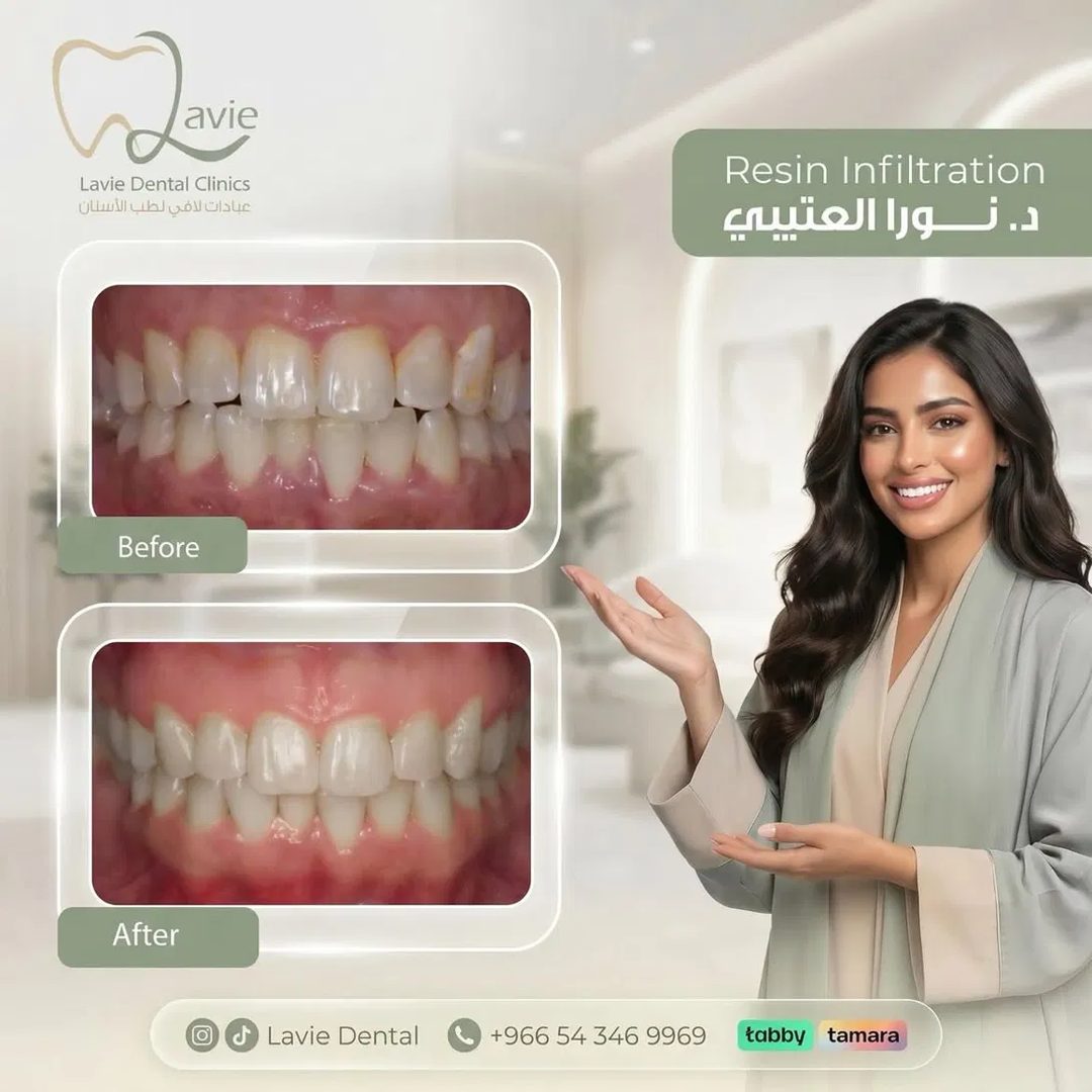 حالة Resin Infiltration قبل وبعد، د. نورا العتيبي، عيادات لافي الرياض
