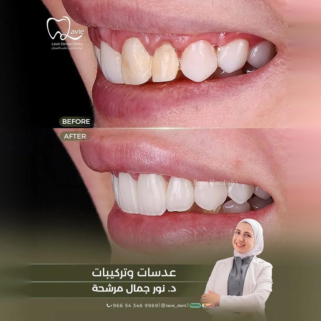 حالة عدسات وتركيبات قبل وبعد، د. نور جمال مرشحة، عيادات لافي الرياض